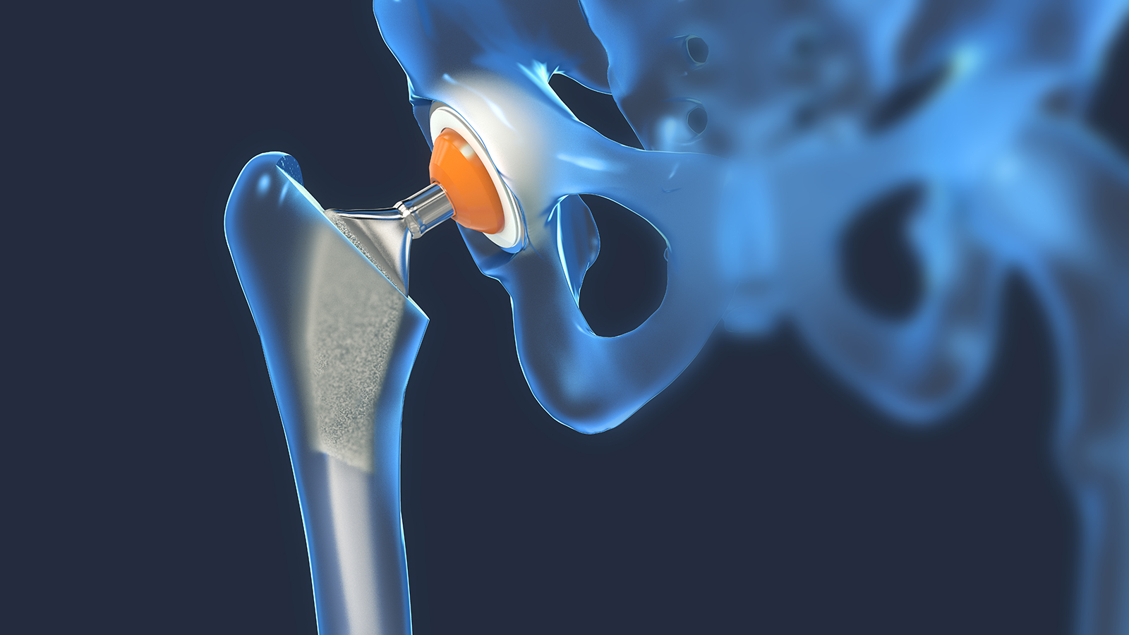 hip replacement surgery